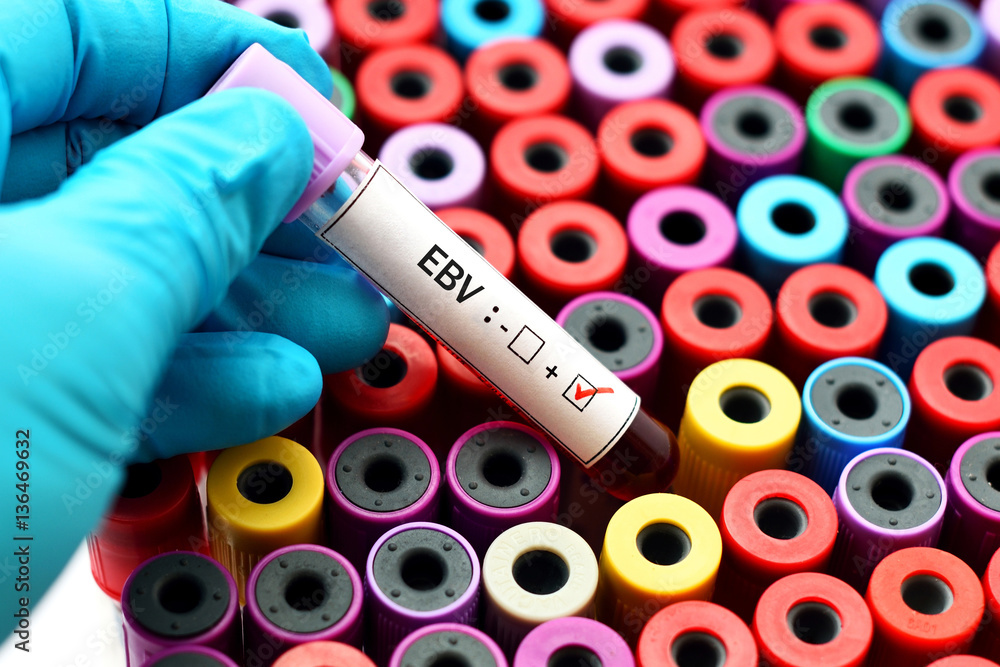 Fototapeta premium Epstein-Barr virus (EBV) positive