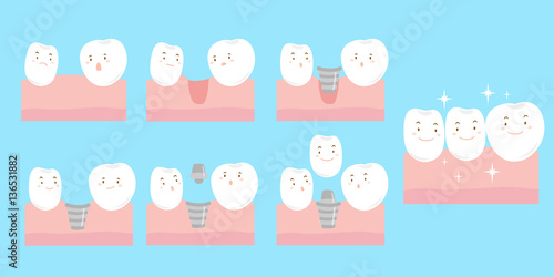 cartoon tooth implant smile happily