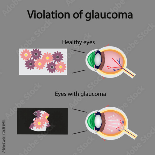 The structure of the eye. Blurred vision in glaucoma. As the eye can see the affected with glaucoma