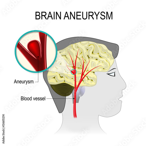 Blood vessels in the brain with aneurysm photo