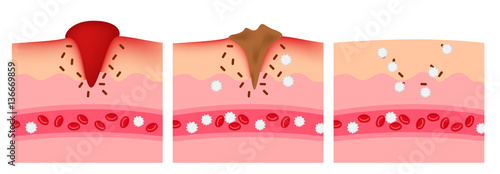 infographic of how the wound heal by platelet and white blood cell vector