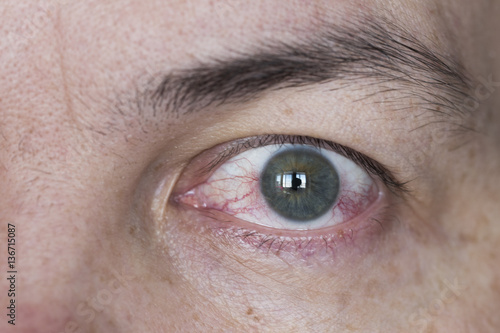 Foto Close up of wide open red and irritated human eye