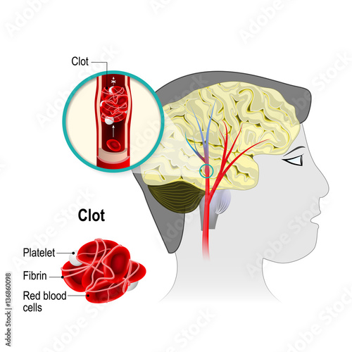 Cerebral infarction