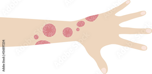 Human hand with psoriasis
