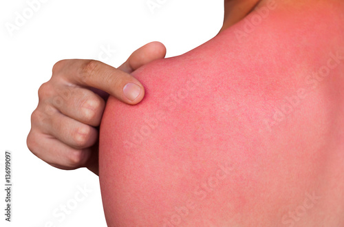 A man with reddened, itchy skin after sunburn. Skin care and protection from the sun's ultraviolet rays. photo