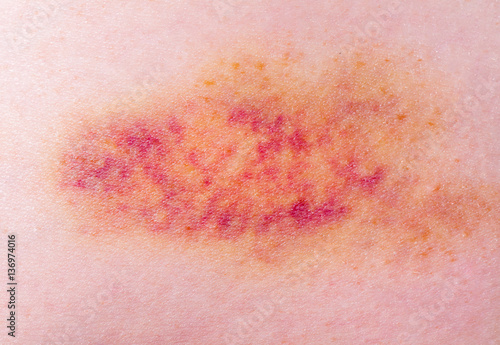 Closeup on a Bruise
