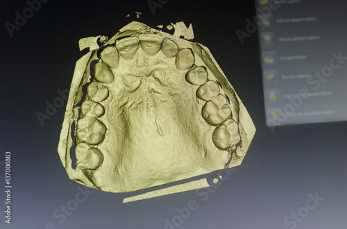 Dental technician is designing a dental crown with a computer.