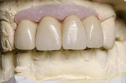 Closeup of dental prosthesis porcelain teeth in a mold