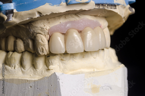 Closeup of dental prosthesis porcelain teeth in a mold