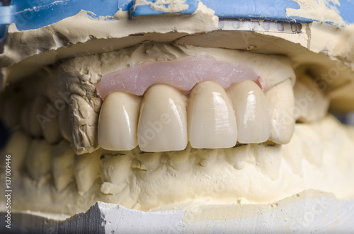 Closeup of dental prosthesis porcelain teeth in a mold