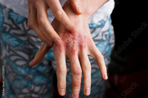 Closeup men itching and scratching by hand. Psoriasis or eczema on the hand. Atopic allergy skin with red spots photo