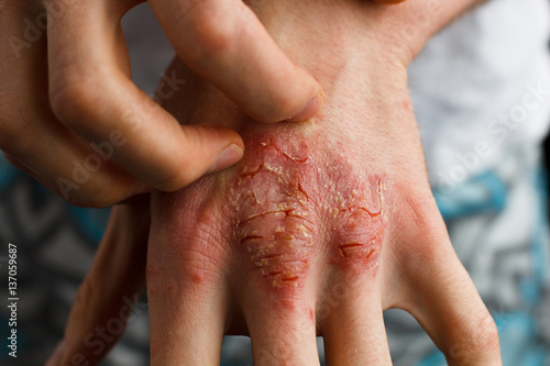 applying an emollient to dry flaky skin as in the treatment of psoriasis, eczema and other dry skin conditions photo