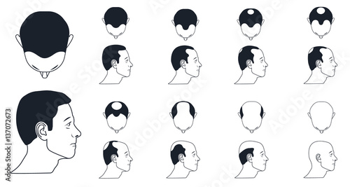types of male baldness, norwood scale icons