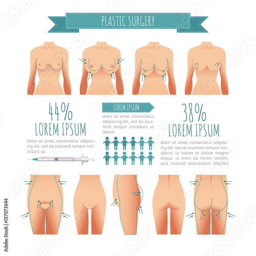 Plastic surgery illustrations. breast lift, abdominoplasty, lipofilling