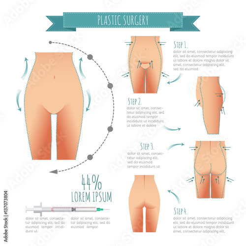 Plastic surgery illustrations. liposuction, lipofilling, abdominoplasty