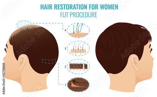 Female hair loss treatment with follicular unit transplantation. Stages of FUT procedure for women. Alopecia infographic medical template. Clinics and diagnostic centers design. Vector illustration.