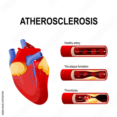 Atherosclerosis stages