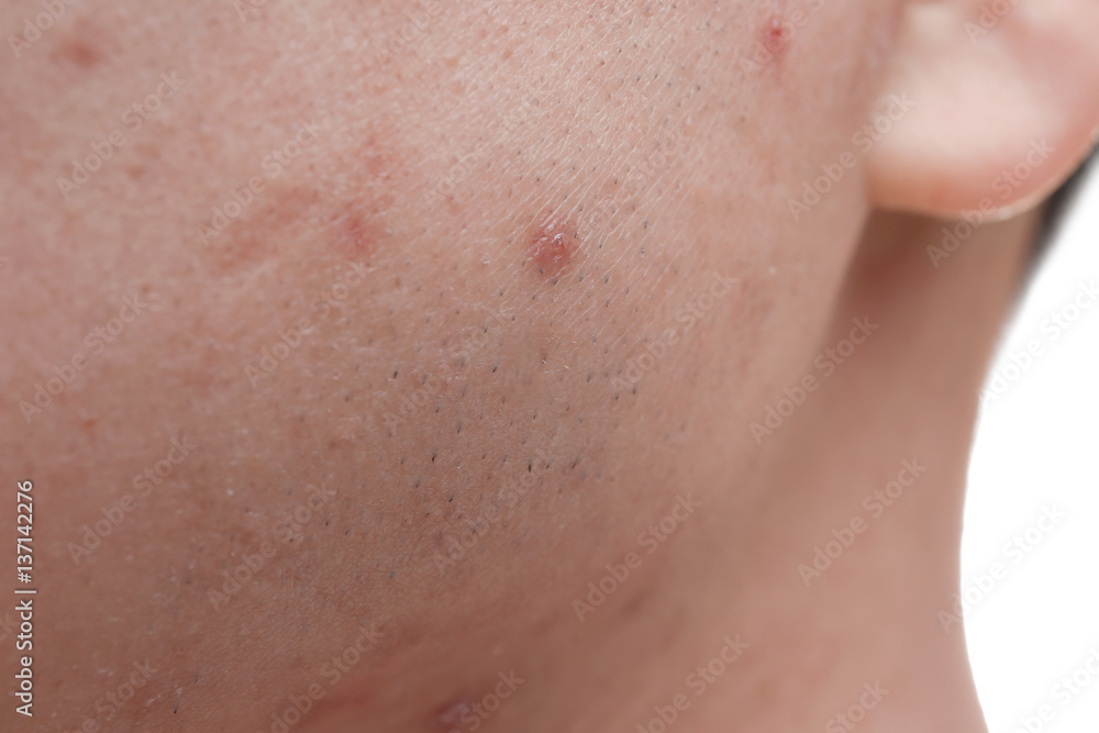 Young man with problem skin, closeup Young man with problem skin, closeup