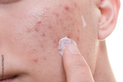 Fototapeta Naklejka Na Ścianę i Meble -  Young man applying cream for problem skin onto face, closeup