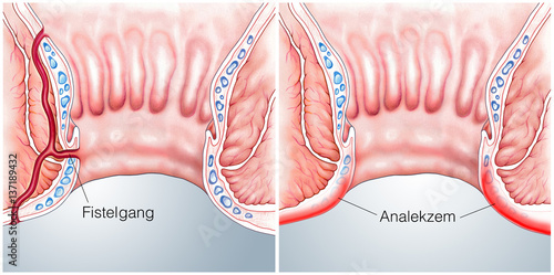 Analfistelgang.Juckendes Analekzem