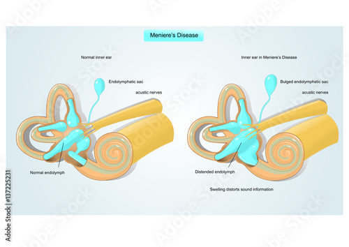 meniere's disease: disorder of the inner ear photo
