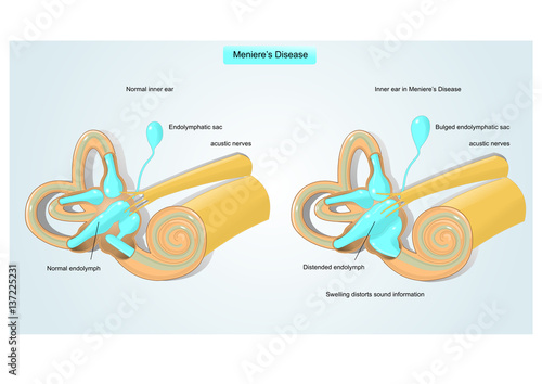 meniere's disease: disorder of the inner ear