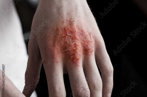Pain red spot on man hand with eczema rash or allergy. Conceptual photo about healtcare and skin problems. Atopic psoriasis close up skin. © Ольга Тернавская