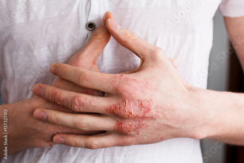 The problem with many people - eczema on hand. White background. Man itchind skin.