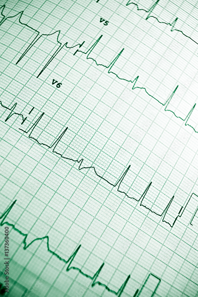 Electrocardiogram Electrocardiogram