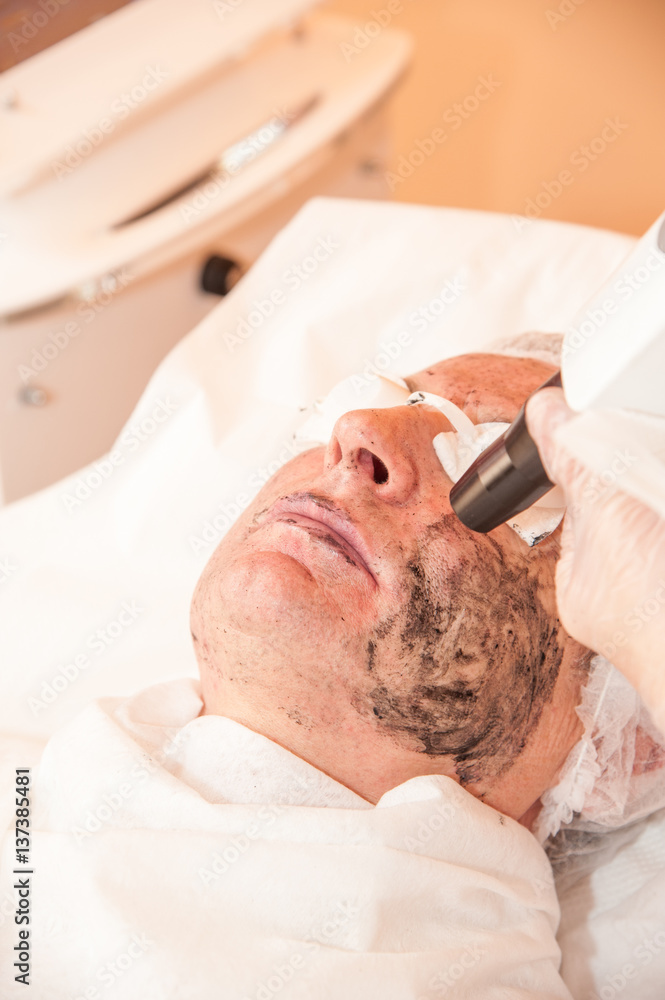Obraz premium carbon laser treatment skin / laser treatment