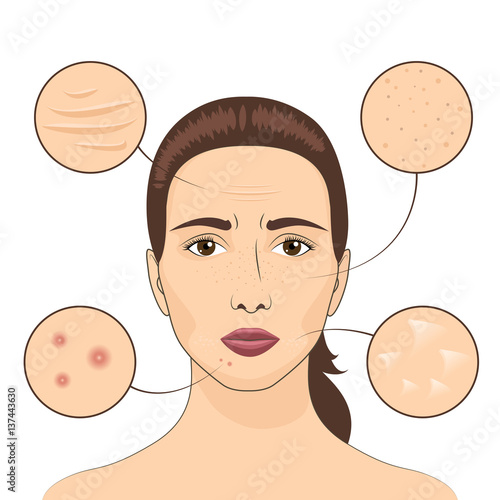 Woman skin problem vector illustration. Female face with skins problematic areas