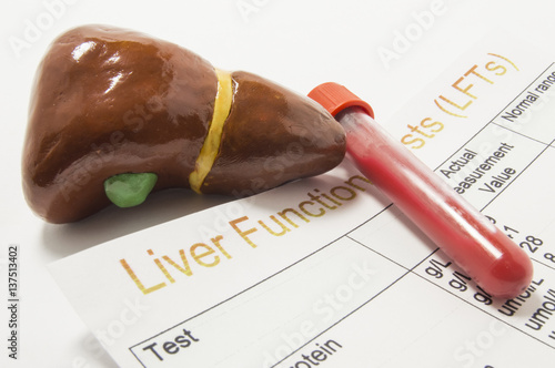 Canvas Print Figure of human liver, laboratory test tube or bottle with blood and paper result of liver function or enzyme test (LFTs) analysis are on doctor table
