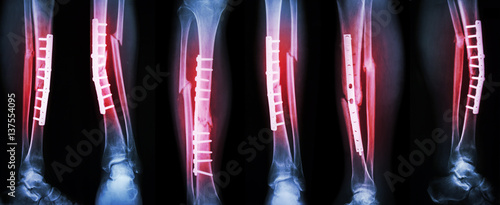 Collection image of leg fracture and surgical treatment by internal fixation with plate and screw . Break tibia and fibula bone .