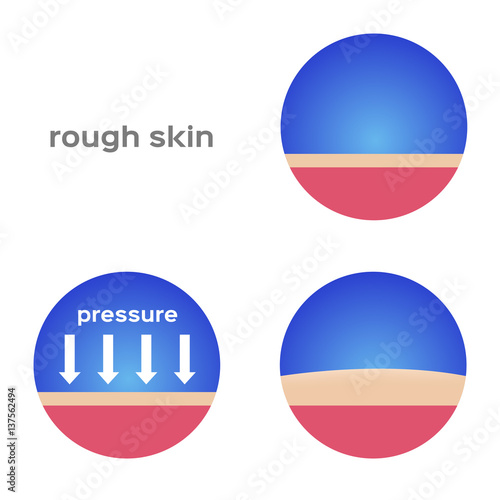 rough skin and callus vector 