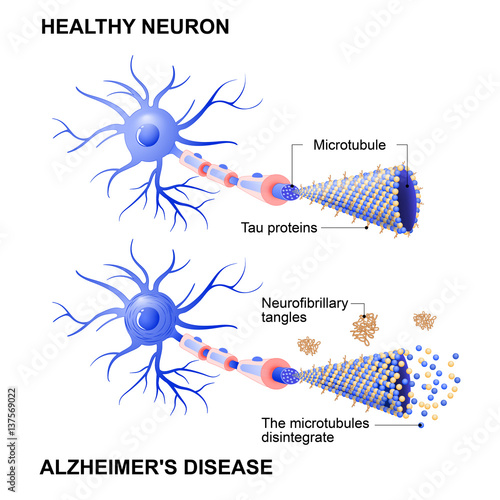 healthy cell and neurons with Alzheimer's disease. Tau hypothesis photo