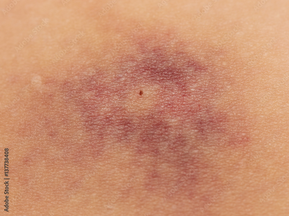 a bruise on the skin a bruise on the skin