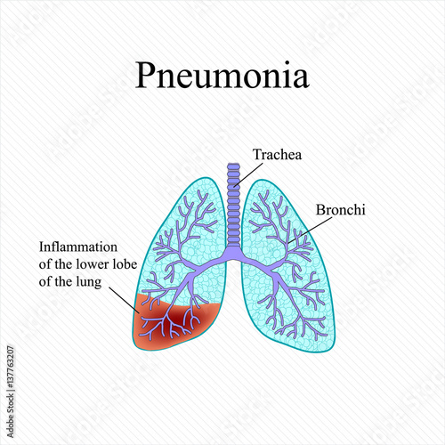 Pneumonia. The anatomical structure of the human lung. Inflammation of the lower lobe of the lung. Vector illustration