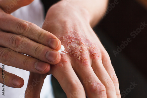 applying an emollient to dry flaky skin as in the treatment of psoriasis, eczema and other dry skin conditions photo