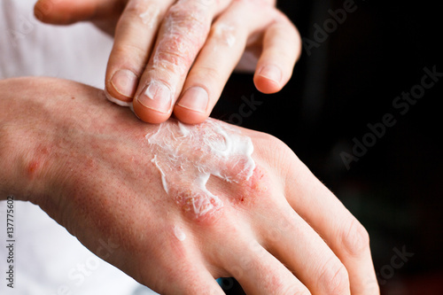 Dermatologist doctor doing treatment, male patient with allergic rash dermatitis eczema skin, Skin diseases. photo