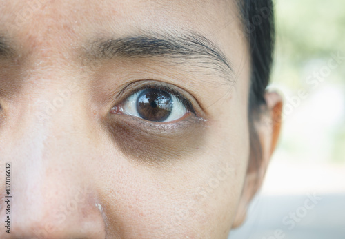 Dark circles around eye.
