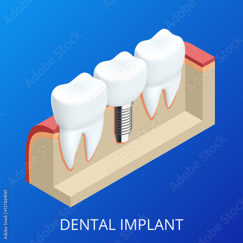Isometric Tooth human implant. Dental concept. Human teeth or dentures. 3d illustration Isolated. Realistic vector illustration