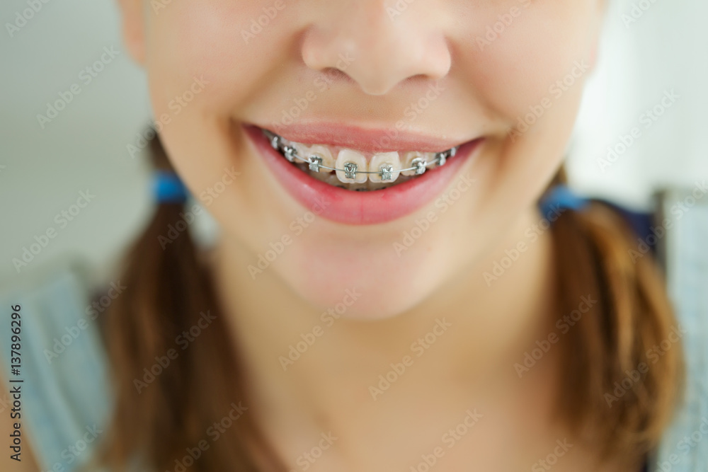Girl with braces Girl with braces