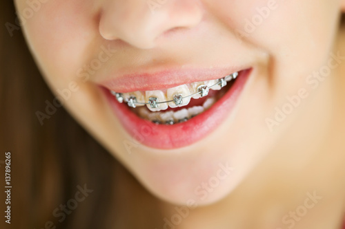 Girl with braces 