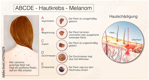 Hautkrebs.Melanom.ABCDE