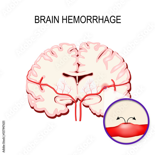cerebral hemorrhage