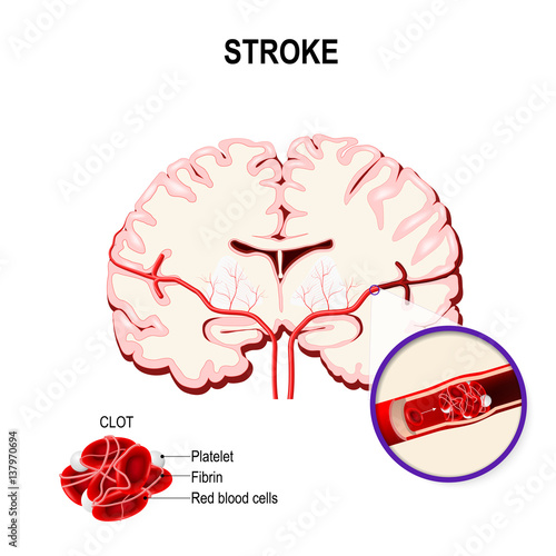 Ischemic stroke in the cerebral artery and thrombus.
