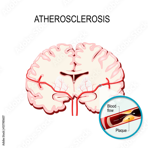 Cross section of the brain Human brain with atherosclerosis.