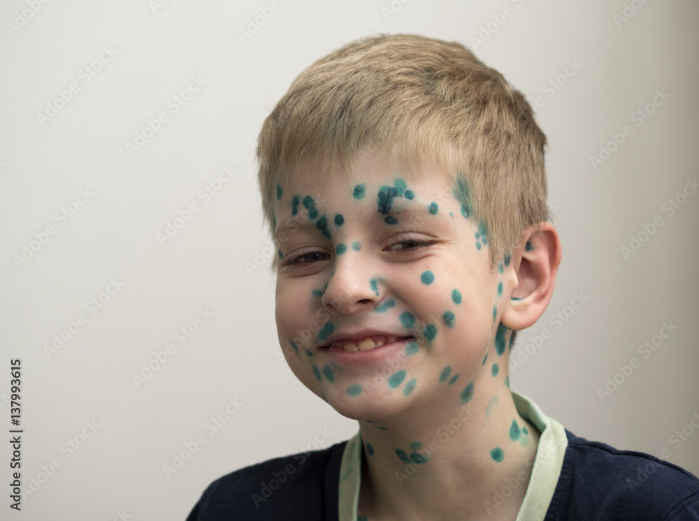 Child with chickenpox foto de Stock Adobe Stock