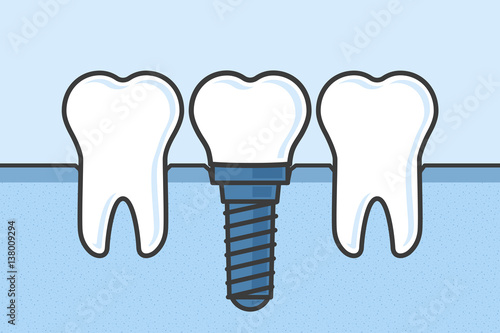 Teeth with dental implant vector illustration.
