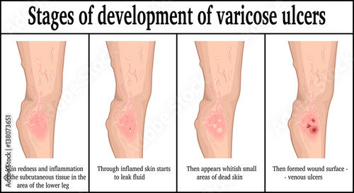 Stages of development of varicose ulcers photo